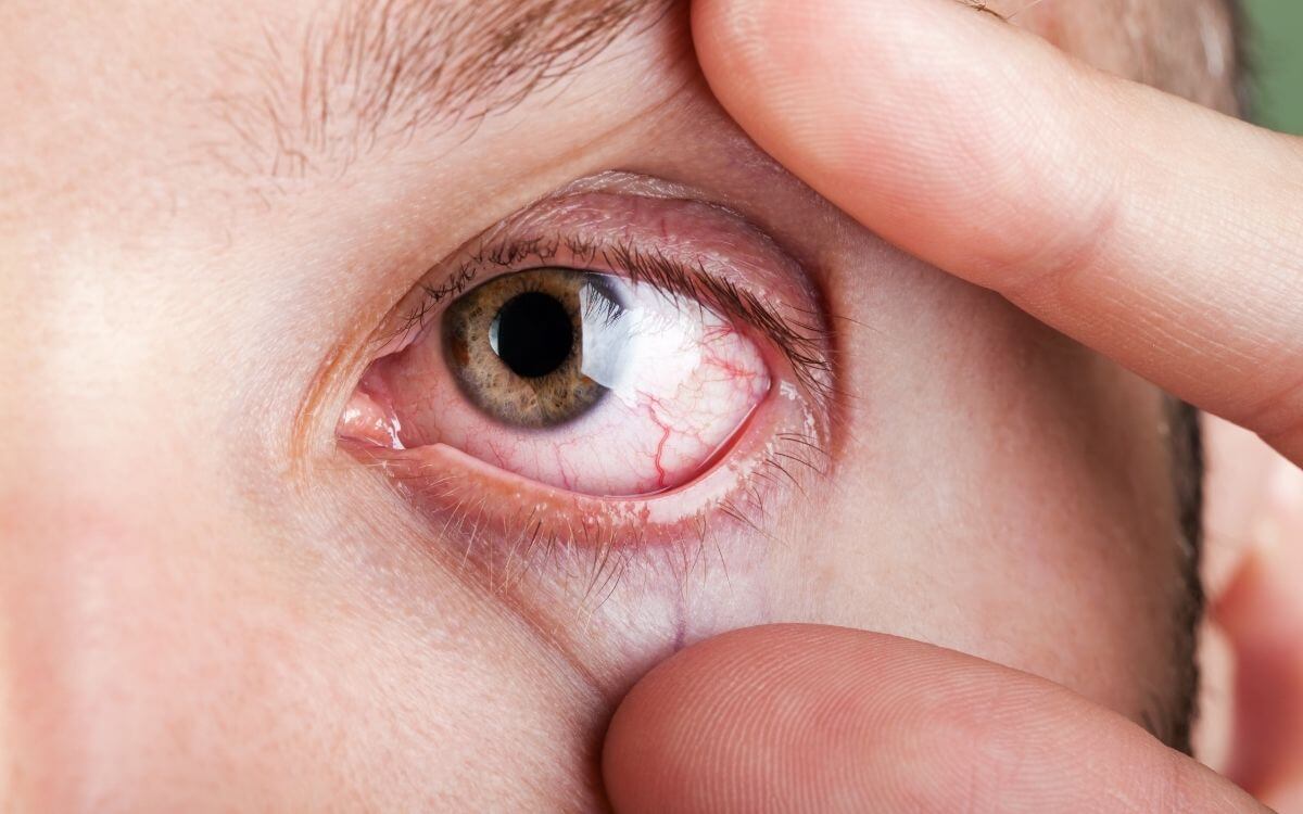 Ojos claros y riesgo de enfermedades oculares